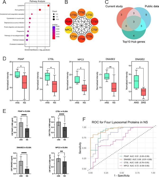 J. Proteome Res. 2026, 25, 2, 713–722: Figure 2. Downregulation of key lysosomal proteins in the cerebrospinal fluid of neurosyphilis patients. (a) KEGG pathway analysis demonstrated that downregulated proteins in patients with NS were significantly enriched in the lysosome pathway, as well as in axon guidance and neurodegeneration. (b) The top 10 hub genes involved in the lysosome pathway were identified using the STRING network data set and PPI analysis. (c) A Venn diagram revealed 3 proteins (PSAP, CTSL, and NPC2) shared across our current data, the public data set (PXD033034) and the top 10 hub genes. (d) The CSF levels of PSAP (Padj = 0.043), CTSL (Padj = 0.028), DNASE2 (Padj = 0.003) and NPC2 (Padj = 0.013) were significantly decreased in the NS group than in the nNS group. Subgroup analysis found a significantly lower expression level of DNASE2 in the SNS group than in the ANS group (P = 0.035). (e) PSAP, DNASE2, CTSL and NPC2 levels in CSF were tested by ELISA in the nNS (n = 56) and NS (n = 21) groups. Compared with those in the nNS group, significantly lower PSAP (P < 0.0001), CTSL (P < 0.0001), DNASE2 (P < 0.0001) and NPC2 (P = 0.0024) levels were detected in the NS group. (f) ROC curve analysis for NS revealed that PSAP had an AUC = 0.91 (95% CI: 0.83–0.99), DNASE2 had an AUC = 0.95 (95% CI: 0.91–0.99), CTSL had an AUC = 0.85 (95% CI: 0.76–0.95), and NPC2 had an AUC = 0.72 (95% CI: 0.59–0.85). NS: neurosyphilis; nNS: non-neurosyphilis; ANS: asymptomatic neurosyphilis; SNS: symptomatic neurosyphilis. ROC: receiver operating characteristic; AUC: area under the curve. * P < 0.05, ** P < 0.01, ****P < 0.0001.